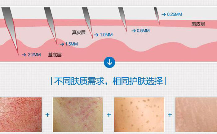 微針去痘坑多少錢一次？