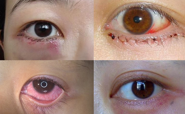 眼袋抽脂多少錢?眼袋抽脂有什么風(fēng)險(xiǎn)嗎?