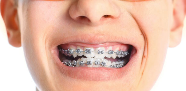 牙齒矯正的最好方法是什么？
