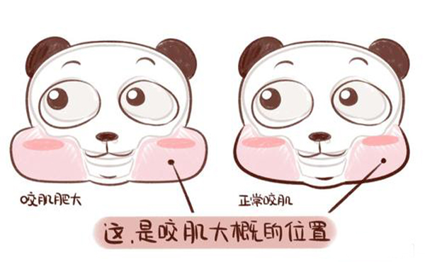 造成咬肌肥大的原因是什么？