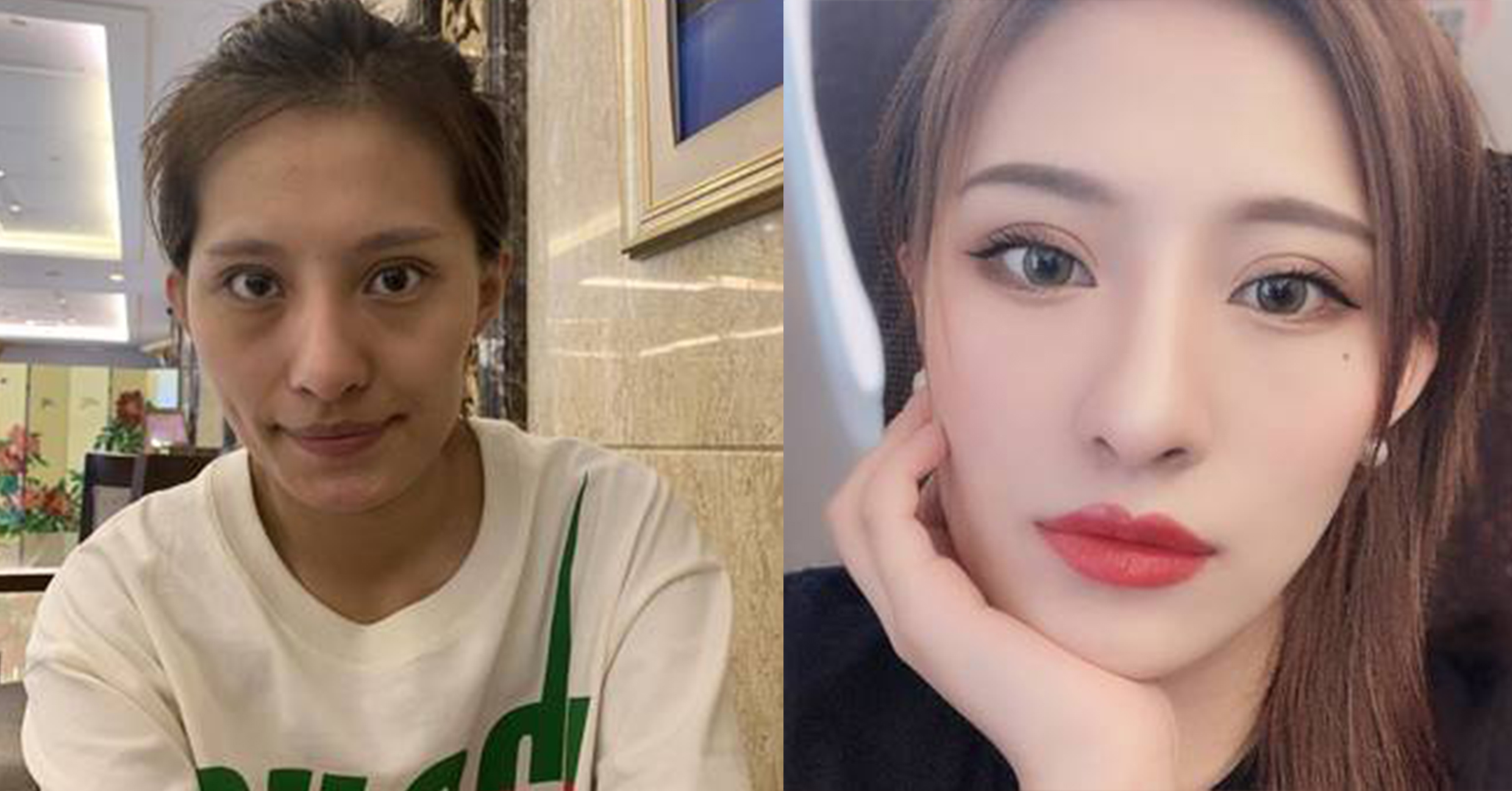 脂肪填充手術(shù)效果對(duì)比1