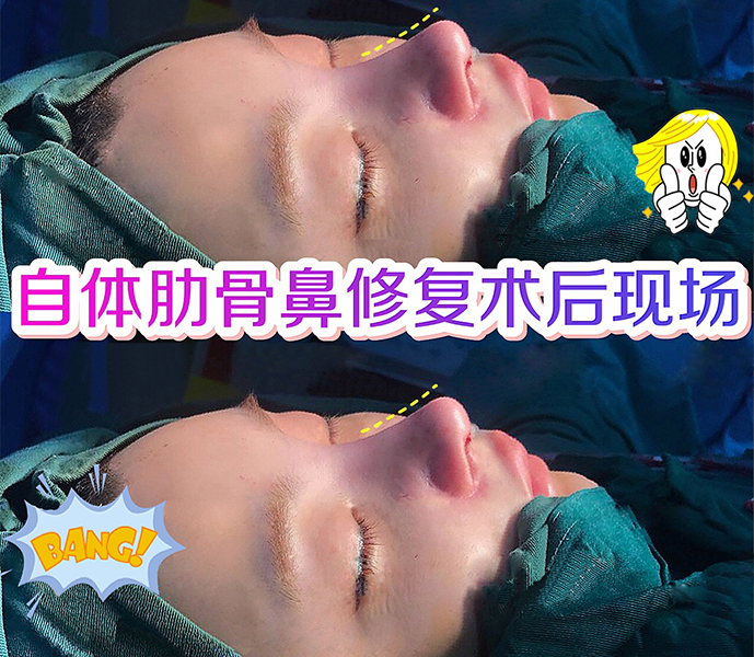 自體肋骨鼻修復(fù)