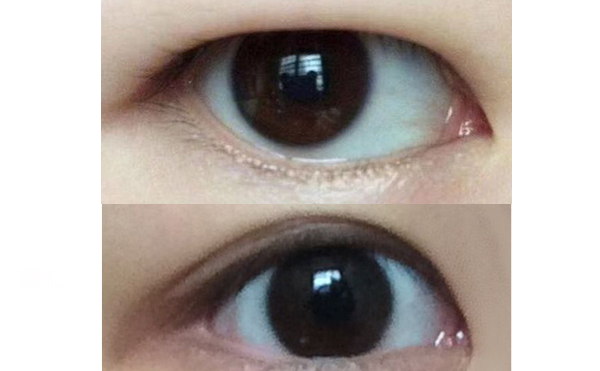 水泡眼矯正術(shù)安全不安全?一般需要多少錢(qián)?