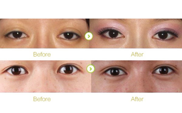 三角眼矯正有哪些優(yōu)點(diǎn)?哪些人不適合做三角眼矯正?