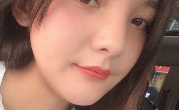 石家莊藍山杜建龍醫(yī)生下頜角整容手術案例術后三個月