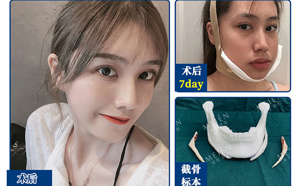 下頜角整形手術(shù)有風險嗎?有什么風險?