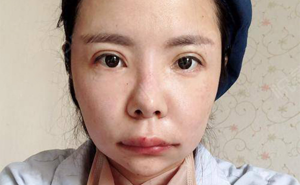 下頜角整形為什么會失敗?下頜角整容失敗如何修復?