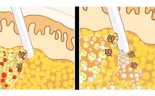 什么是水動(dòng)力吸脂？