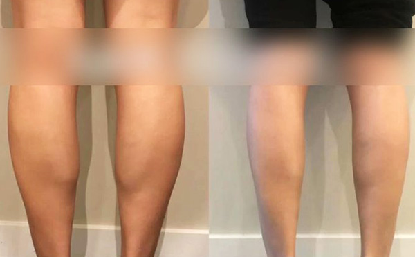 打瘦腿針是怎么操作的？