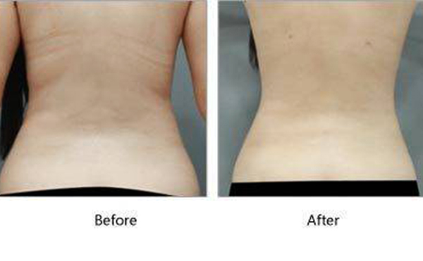 吸脂瘦背部多少錢(qián)？