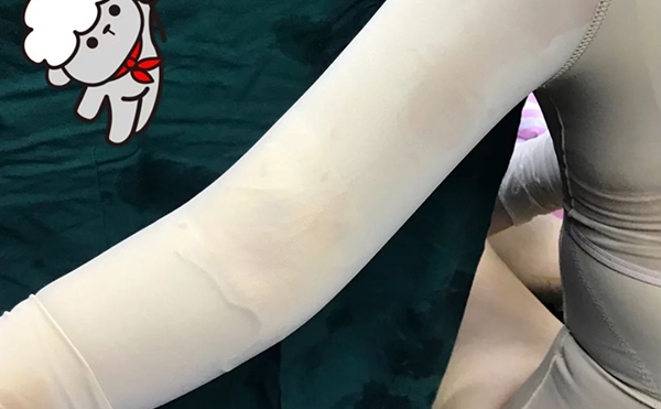 超聲波吸脂瘦手臂安全嗎？