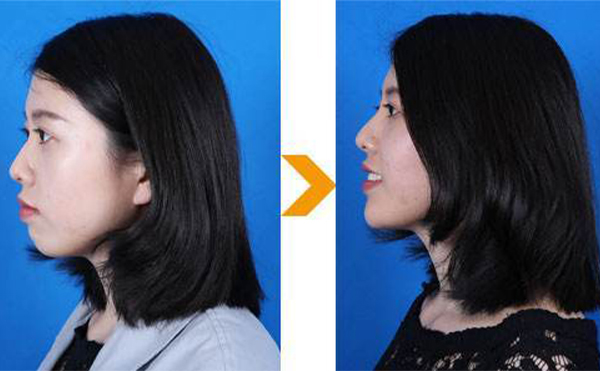 可以用肋軟骨來隆下巴嗎?什么材料隆下巴比較好?