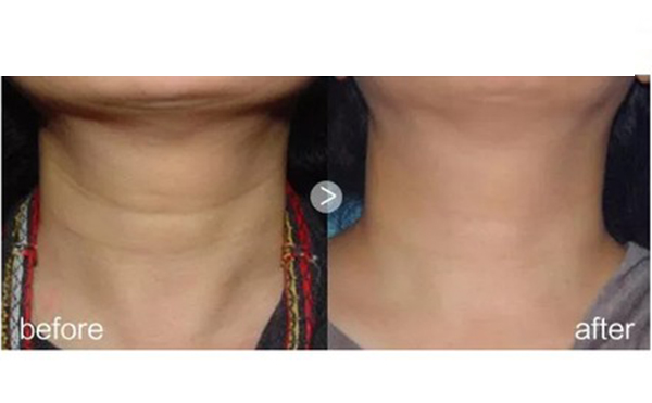 哪些人不能做嗨體？