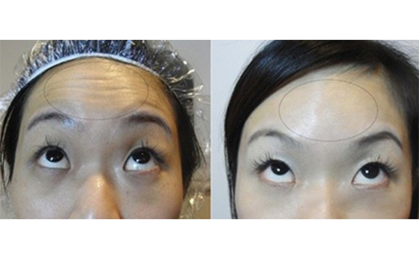 玻尿酸能去抬頭紋嗎？