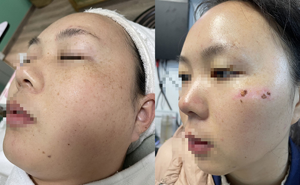 彩光嫩膚有沒有副作用？