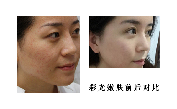 皮膚薄能做彩光嫩膚嗎？