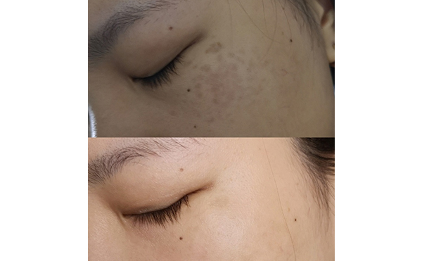 激光美白能維持多久？