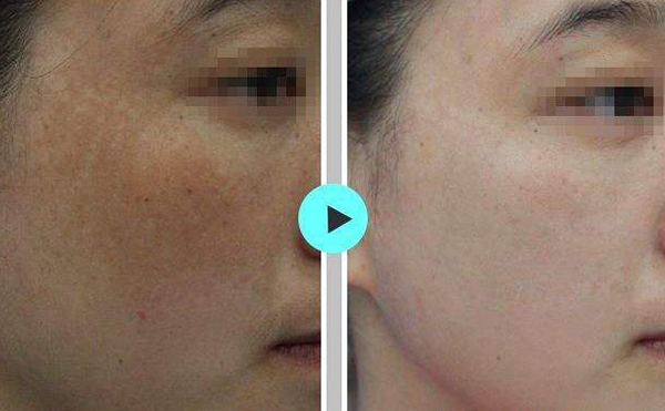 激光祛斑會使皮膚變薄嗎？