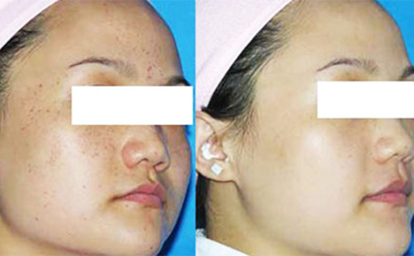 激光祛斑治療一次要多久？