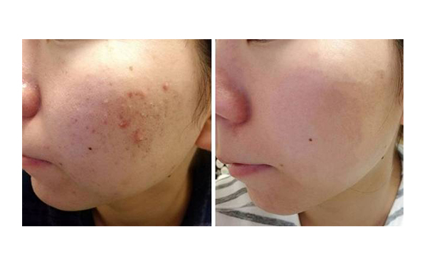 白瓷娃娃的治療過程是什么？