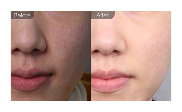 e光嫩膚適合哪些人？