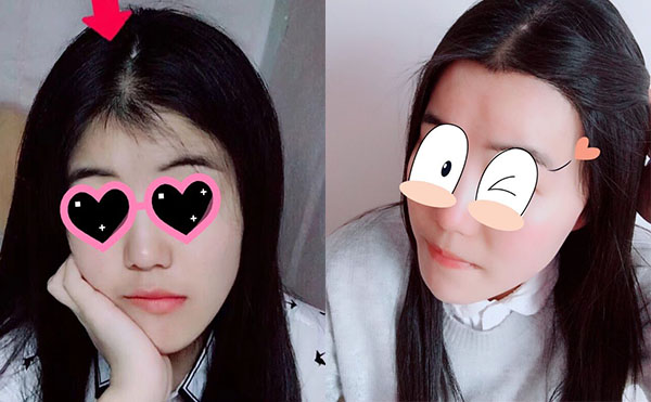 冰點(diǎn)脫毛發(fā)際線怎么樣？