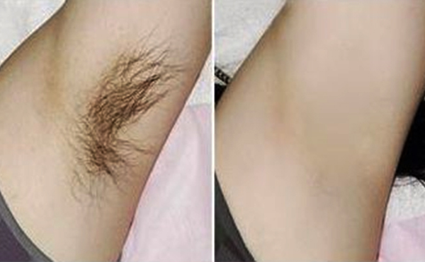 光子脫腋毛有什么優(yōu)勢？