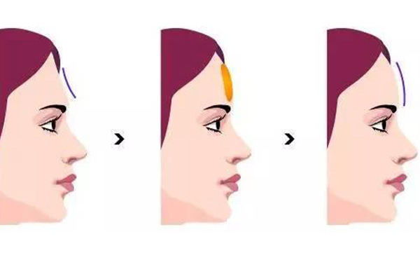 玻尿酸豐額頭怎么樣?適合哪些人?術(shù)前術(shù)后要注意什么?