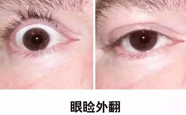 醫(yī)美技術(shù)越來越發(fā)達，不少愛美的人本著變美的心情滿懷期待地去做雙眼皮、開眼角等項目，不料整容不成、反倒毀容，后悔也來不及。有些做雙眼皮的姑娘術(shù)后出現(xiàn)眼瞼外翻的情況，那眼瞼外翻是什么意思?上眼瞼外翻如何修復(fù)?
