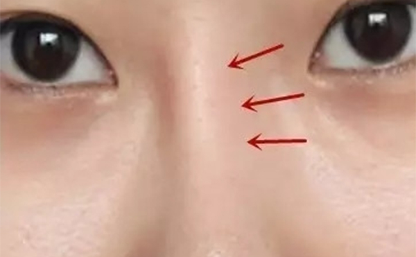 假體隆鼻時(shí)間長了出現(xiàn)假體移位等并發(fā)癥后該怎么辦？