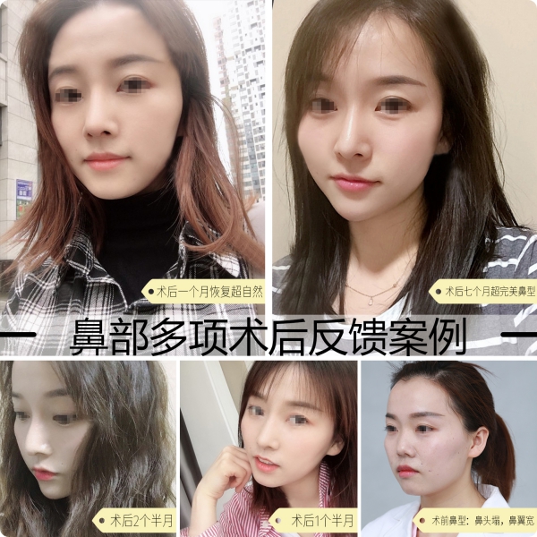 隆鼻手術(shù)