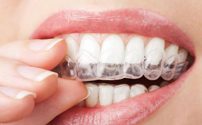 手術(shù)矯正牙齒費用大概多少？手術(shù)矯正牙齒怎么矯正？