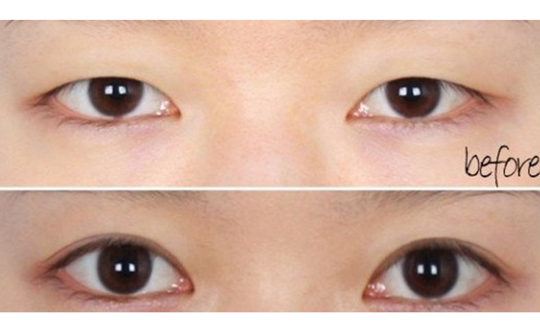 上瞼下垂一定要做嗎?上瞼下垂修復效果好嗎?