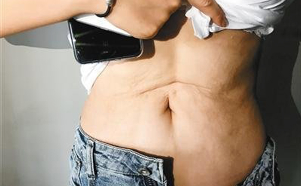 腹部吸脂術(shù)后為什么會凹陷?好修復(fù)嗎?