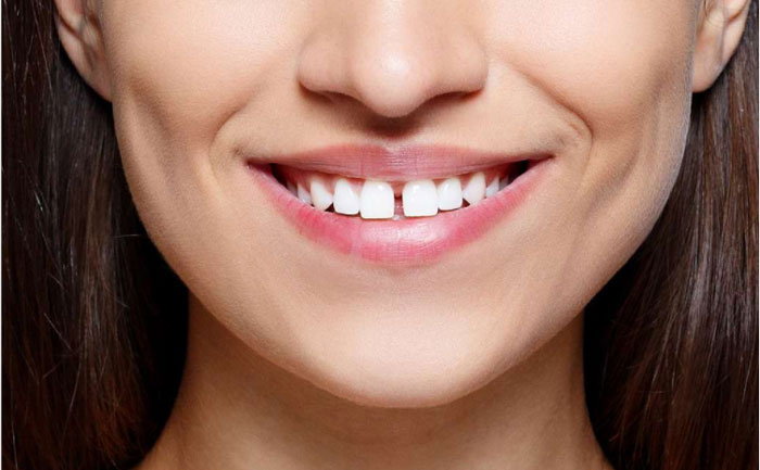 牙縫大可以矯正嗎？