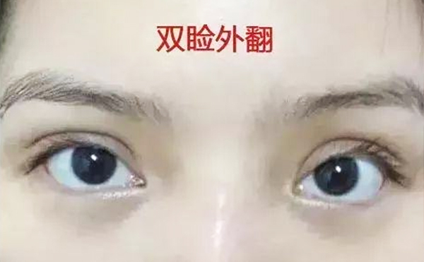眼瞼外翻術(shù)前需要注意什么?術(shù)后怎么護(hù)理?