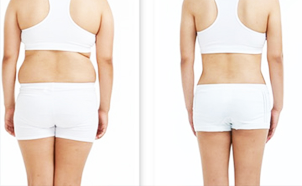 腹部吸脂手術(shù)有哪些常見問題？