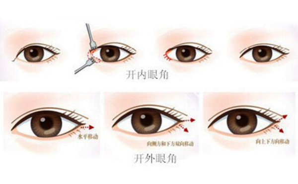 開眼角是怎么開的?開眼角效果大嗎?