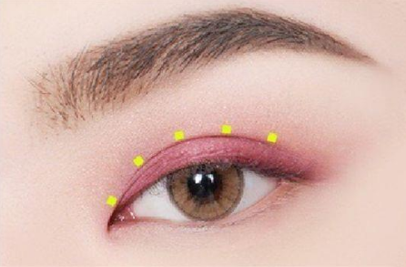 自體脂肪豐眼窩成活率高嗎？