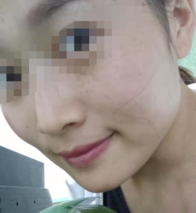 南寧東方整形祛斑案例效果對比3