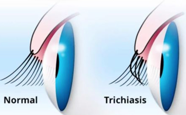 倒睫與亂睫的區(qū)別是什么?倒睫與亂睫怎么辦?