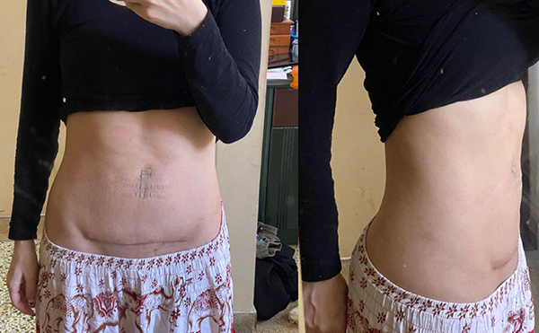 腹壁成形術(shù)安全嗎?有什么風(fēng)險(xiǎn)?