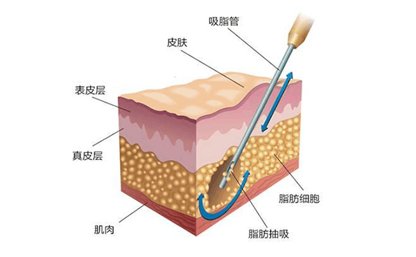 背部吸脂術后會留疤嗎?會不會反彈?