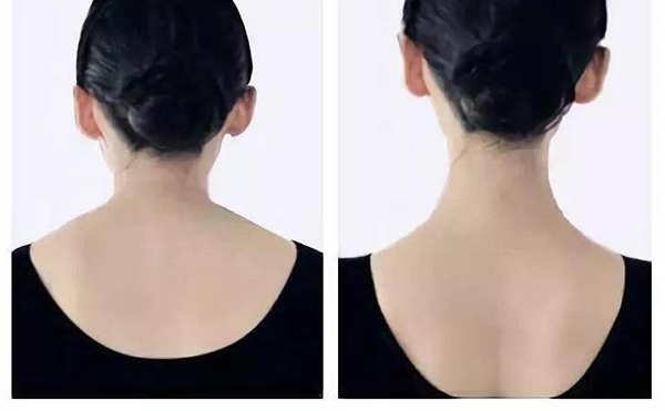 瘦肩針是用什么打的？