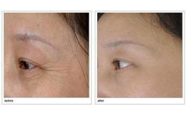 玻尿酸去魚尾紋多久注射一次？