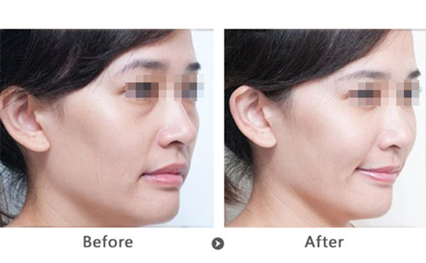 玻尿酸去法令紋多少錢(qián)？