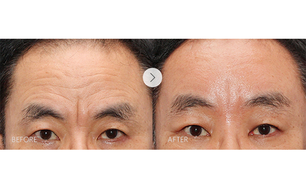 玻尿酸去抬頭紋安全嗎？