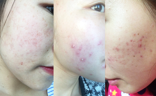 長痘期間能打水光針嗎