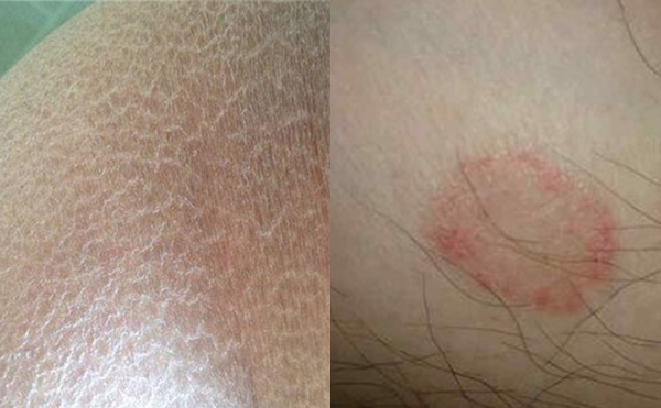 脫腋毛有什么副作用嗎？