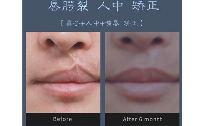 唇裂修復(fù)術(shù)需要多少錢？